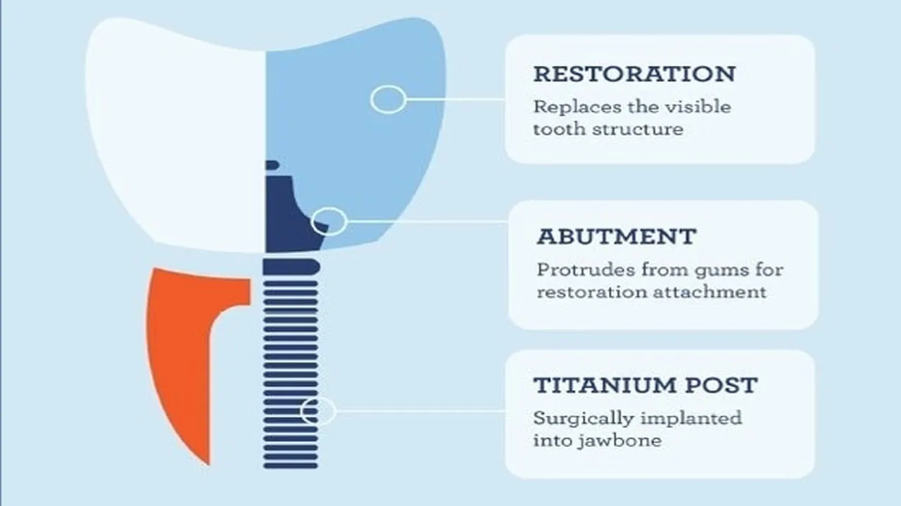 Abutment